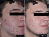 Gold-coated microparticles aid acne treatment