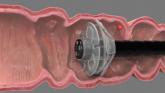 EndoRings-assisted colonoscopy hikes polyp, adenoma detection