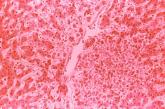 Fatal U.S. dengue fever case misdiagnosed as West Nile virus