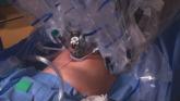 da Vinci Single-Site, the virtually scarless intra-abdominal hysterectomy