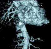 Failure to rescue drives AAA repair mortality