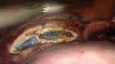 Total Laparoscopic Hysterectomy