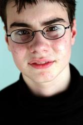 Tweeting the truth about acne