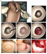 Hydrogel repaired joint defects, sped healing