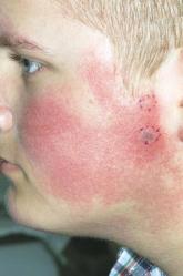 Pulsed dye laser targets keratosis pilaris rubra