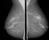 Abbreviated MRI breast cancer screening protocol accurate