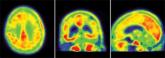In vivo tau imaging confirms patient’s Alzheimer’s diagnosis