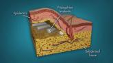 Panel backs approval of implants for addiction treatment