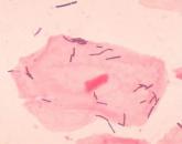 Preterm birth prevention – let’s get the bugs out