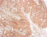 CCR7 Predicts Cervical Metastasis in Oral Cancer