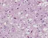 New Creutzfeldt-Jakob disease tests have high sensitivities, specificities
