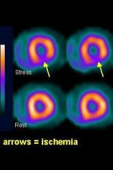 Cardiac stress-imaging in stable angina patients