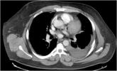 Two-Step Rule Sizes Up CT Pleural Effusions 