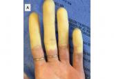 Treating Raynaud phenomenon: Beyond staying warm
