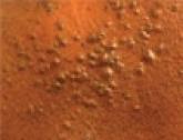 Multiple Eruptive Milia