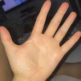 Woman, 18, With Sore Throat, Fever, and Painful Rash