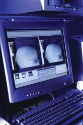 CT scans overused for children’s head traumas