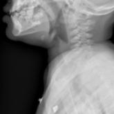 Stridor in the Pediatric Patient