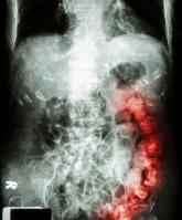 Peripheral opioid blocker eases opioid-induced constipation without inducing withdrawal