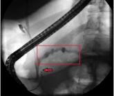 Pancreatitis: The great masquerader?