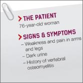 Weakness and pain in arms and legs • dark urine • history of vertebral osteomyelitis • Dx? 
