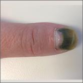 Green fingernail