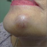 1.5-cm nodule on chin