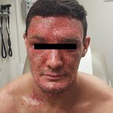 Diffuse facial rash in a former collegiate wrestler
