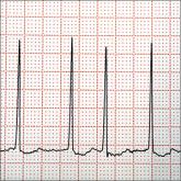 Does left atrial appendage closure reduce stroke rates as well as oral anticoagulants and antiplatelet meds in A-fib patients?
