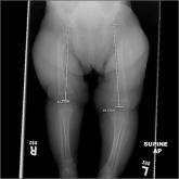 Leg-length discrepancy • asymmetric gluteal folds and popliteal fossae • positive Galeazzi test • Dx?