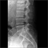 What are the best treatments for reducing osteoporotic compression fracture pain?