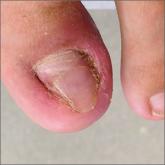 A practical guide to the care of ingrown toenails