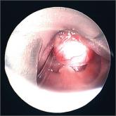 Surgical resection of the base-of-tongue cyst