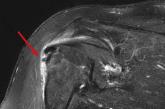 MRI reveals subacromial subdeltoid bursal inflammation