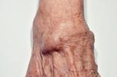 Wrist ganglion cyst