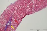 Microvesicular steatosis and minimal portal lymphocytic inflammation