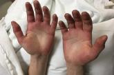 Acute bilateral hand edema and vesiculation