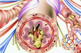 Bronchiole in a patient with asthma