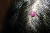 Lobulated pink nodule on the scalp