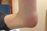 Painful, swollen elbow