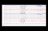 EEG revealed cortical hyperexcitability