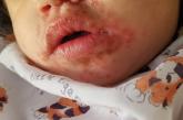 Confluent crusted plaques on lips, perioral skin
