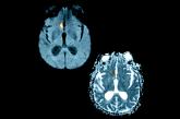 What imaging can disclose about suspected stroke and its Tx