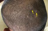 Itchy scalp with scale