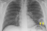 X-ray revealed a large, thick-walled cavitary lesion in the left lower lobe with an air-fluid level