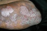 Psoriasis