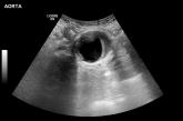 Can family physicians accurately screen for AAA with point-of-care ultrasound?