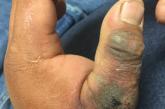 Necrotic ulceration, erythema, and edema of the hand