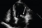 Transthoracic echocardiogram reveals large mass on mitral valve