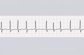 A-fib